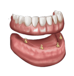 Implant-Retained